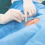 Punção Venosa Central